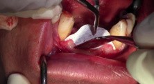 Minimally Invasive Ridge Augmentation