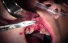 Bone Grafting & Suturing Technique - Extraction #7 With Socket Grafting