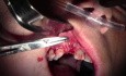 Bone Grafting & Suturing Technique - Extraction #7 With Socket Grafting