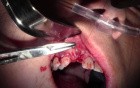 Bone Grafting & Suturing Technique - Extraction #7 With Socket Grafting