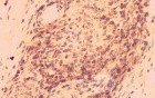 Gastrointestinal Stromal tumor (GIST) (64 of 65)