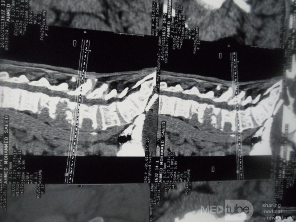 Pancreas cancer - 9