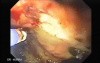 Gastrointestinal Bleeding Caused by Advanced Gastric Carcinoma - Ablation