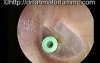 Grommet In-Situ