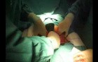 Caesarean Section for Acute Fetal Distress in an Obese Mother, Emergency Case
