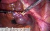Treatment for Ectopic Pregnancy - Salpingostomy by Use of Laparoscopic Surgery