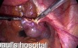 Treatment for Ectopic Pregnancy - Salpingostomy by Use of Laparoscopic Surgery