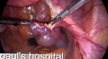 Treatment for Ectopic Pregnancy - Salpingostomy by Use of Laparoscopic Surgery