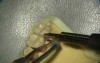 Ultrasonic Endoscopic  Debridement Simulation (UL Palatal)
