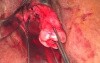 Removal of the Uterus Through the Vagina, Part 1