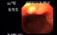Esophagitis - Severe Case
