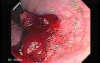 Tubulo - Villous Rectal Adenoma - Endoscopy (8 of 35)