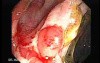 Severe case of Ischemic Colitis (4 of 19)