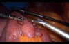 Laparoscopic Gastric Bypass - Part 3