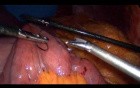 Laparoscopic Gastric Bypass - Part 3