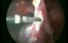 Laparoscopic Ovarian Cyst Removal