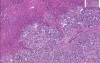 Pancreatic Carcinoma - Histopathology of kidney, liver, heart