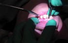 Apicoectomy Incisions