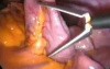 Laparoscopic excision of choledochal cyst type I