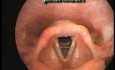 Laryngeal Movements and vocal folds positions