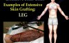 Extensive Skin Graft - Video Lecture - Part 2