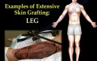 Extensive Skin Graft - Video Lecture - Part 2