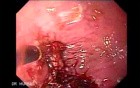 Debulking Of The Esophageal Tumor - Forceps - 2/2