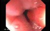 Multiple Adenomatous Polyps Of The Rectum (3 of 37)