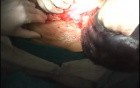 An Emergency Case - a Huge Benign Ovarian Cyst Torsion