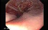 Adenocarcinoma of the Cardias - Beginning of the Procedure
