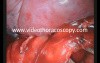Single Port VATS Lobectomy Left Upper Lobe
