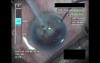 Cataract Surgery VIII - Part 2