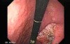 Endoscopy of small gastric cancer