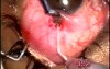 Tenon cyst formation and failure after earlier surgery. Singh filtration