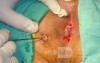 Fistula in Ano (5 of 7)