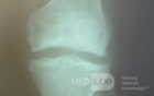 Fairbank Lesion