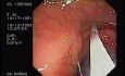 Tubulo - Villous Adenoma - Endoscopy (19 of 28)