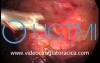 Anterior Mediastinal Mass Thoracoscopic Resection