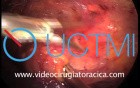 Anterior Mediastinal Mass Thoracoscopic Resection