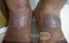 Neurodermatitis