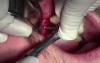 Implant Surgery #6 - Screwplant, Implant Direct, Mineross Regenerated Bone