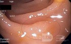 Serrated Adenoma