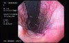 Banding of Esophageal Varices - Quick Look at the Varices