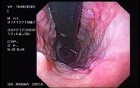 Banding of Esophageal Varices - Quick Look at the Varices