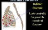 Types of Sternal Fractures - Video Lecture
