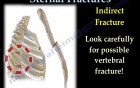 Types of Sternal Fractures - Video Lecture