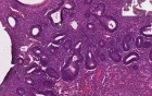 Hyperplasia - Histopathology - Endometrium