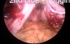 Laparoscopic sleeve gastrectomy