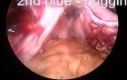 Laparoscopic sleeve gastrectomy