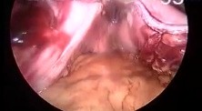 Laparoscopic sleeve gastrectomy